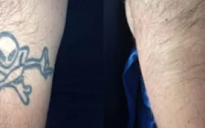 Antes y Después Borrado de Tatuaje