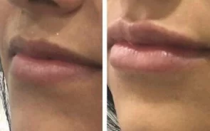Resultados relleno de labios con ácido hialurónico
