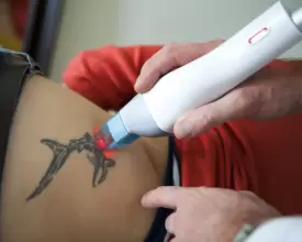 Remocin de tatuajes