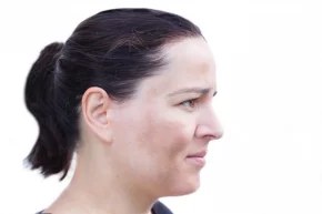 Tratamientos para eliminar las manchas de sol en el rostro - Rejuvenecimiento Facial