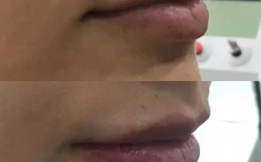 Resultados de aumento de labios