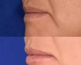 Relleno y aumento de labios