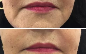 Antes y después de rejuvencimiento facial