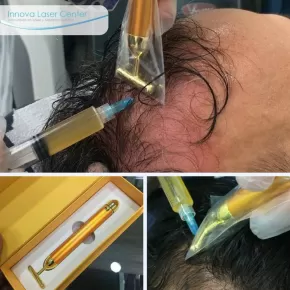 Tratamiento revitalización capilar